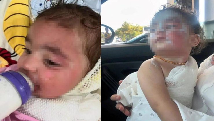 Kreşte facia: Okul ‘Türk kahve döküldü’ dedi aile inanmadı: Yanıklar çok daha derin…